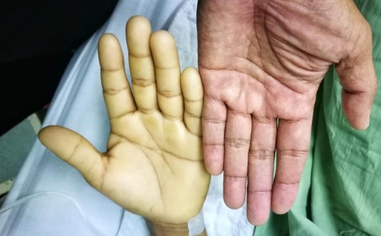 Anaemia