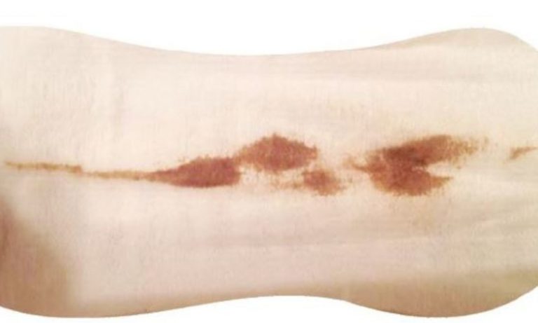 Why is My Virginal Discharge Brown? 5 virginal infections you should know