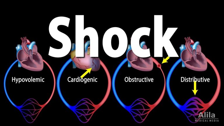 shock
