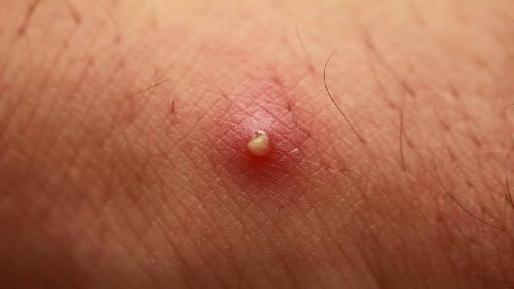 Pimples: are they food to avoid if I have one? 1 images 83 resize 84 ExampleNG