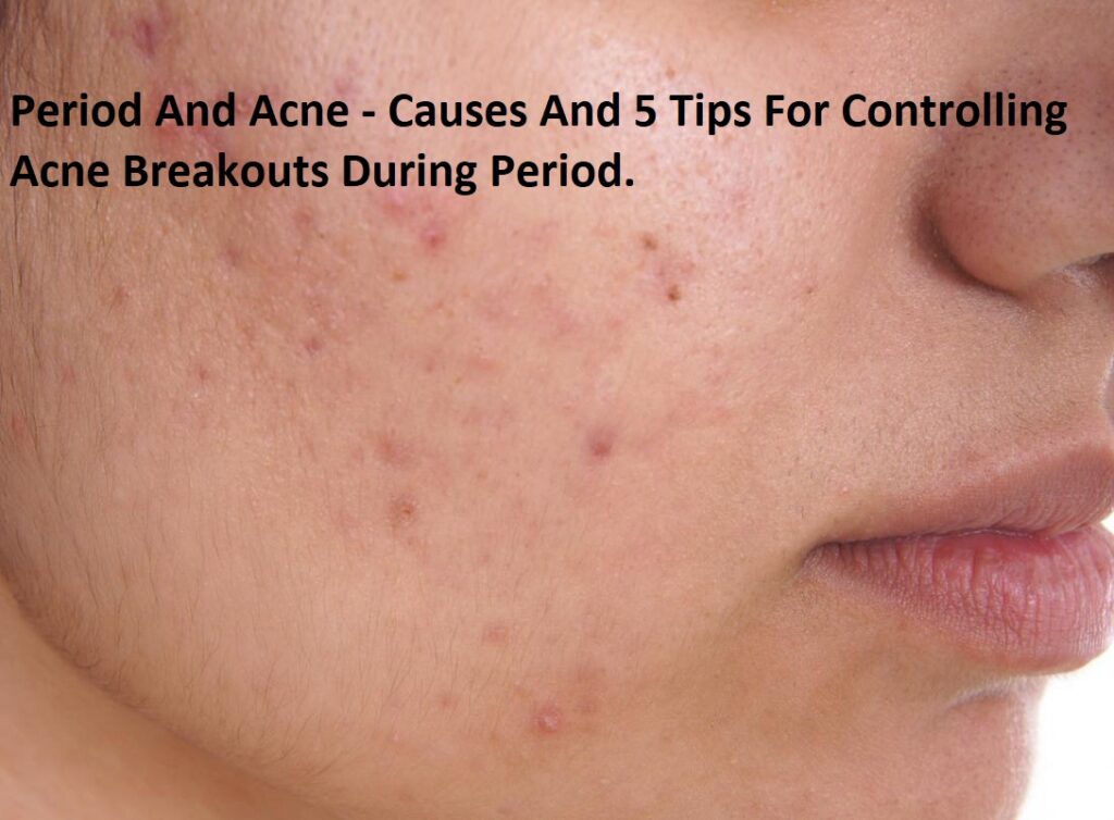 Period And Acne - Causes And 5 Tips For Controlling Acne Breakouts During Period.