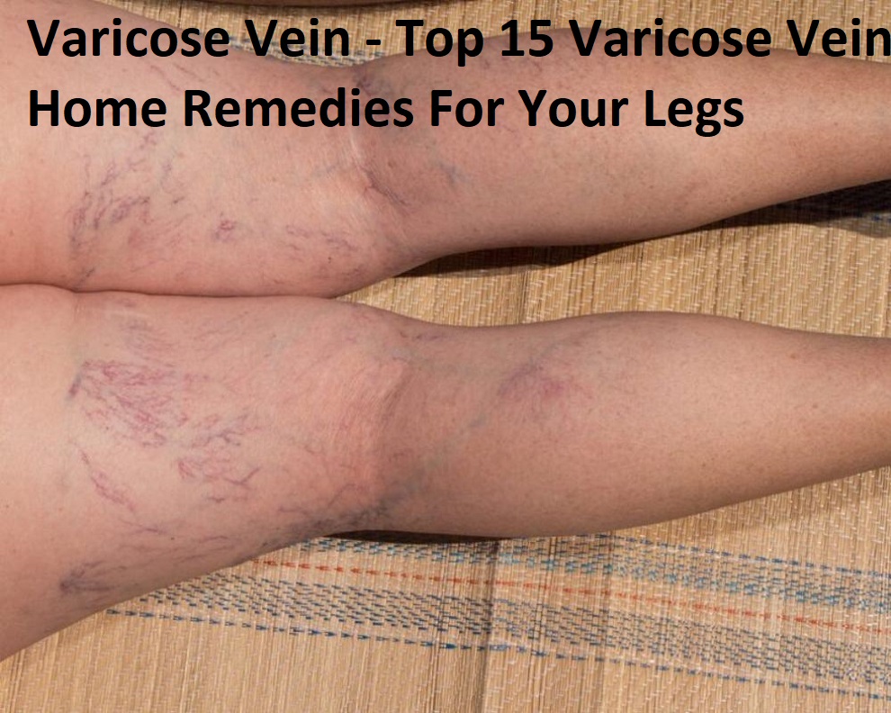 Varicose Vein - Top 15 Varicose Vein Home Remedies For Your Legs