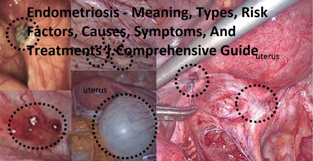 Endometriosis - Meaning, Types, Risk Factors, Causes, Symptoms, And Treatments | Comprehensive Guide