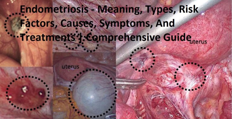 Endometriosis – Meaning, Types, Risk Factors, Causes, Symptoms, And Treatments | Comprehensive Guide Endometriosis – Meaning, Types, Risk Factors, Causes, Symptoms, And Treatments | Comprehensive Guide