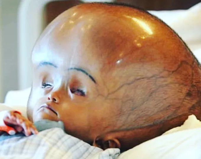 Hydrocephalus In Infants And Adults - Meaning, Causes, 25 Symptoms, Prevention And Best Treatments 3 Hydrocephalus In Infants And Adults - Meaning, Causes, Symptom, Prevention And Treatment