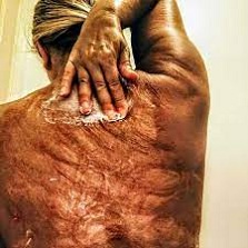 Sunburn: All you need to know