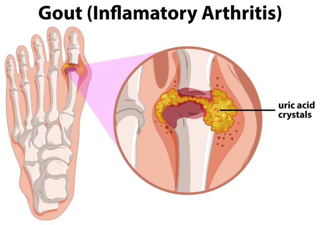 What is Gout: Symptoms, Causes, Treatment, Risk Factors and more