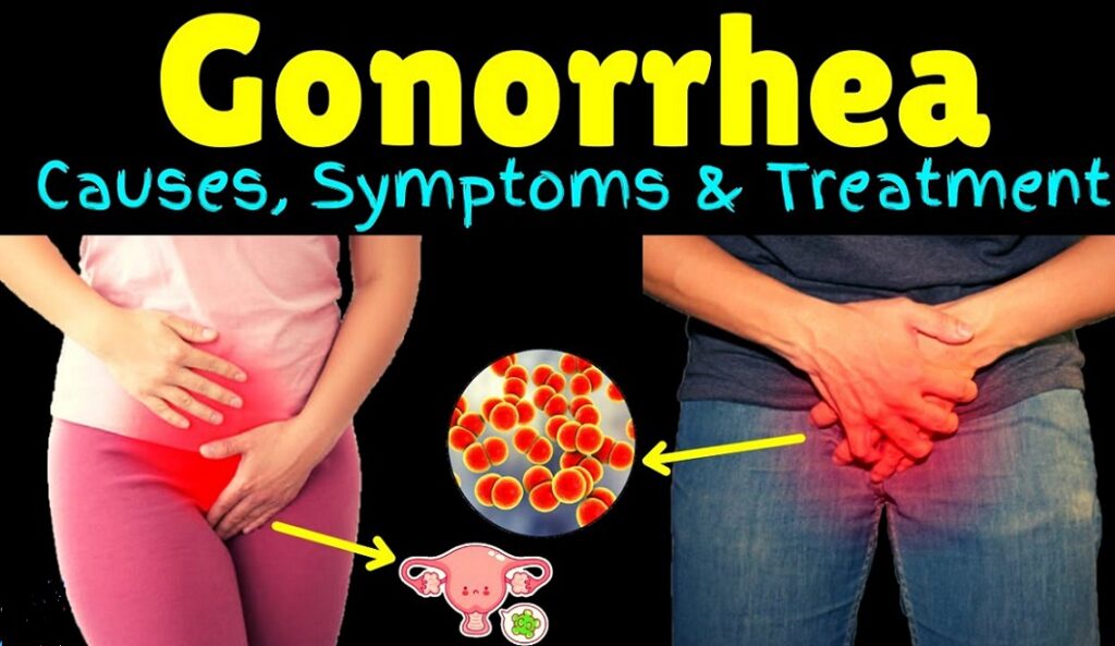 Gonorrhea: Symptoms, Causes, Prevention and Treatment